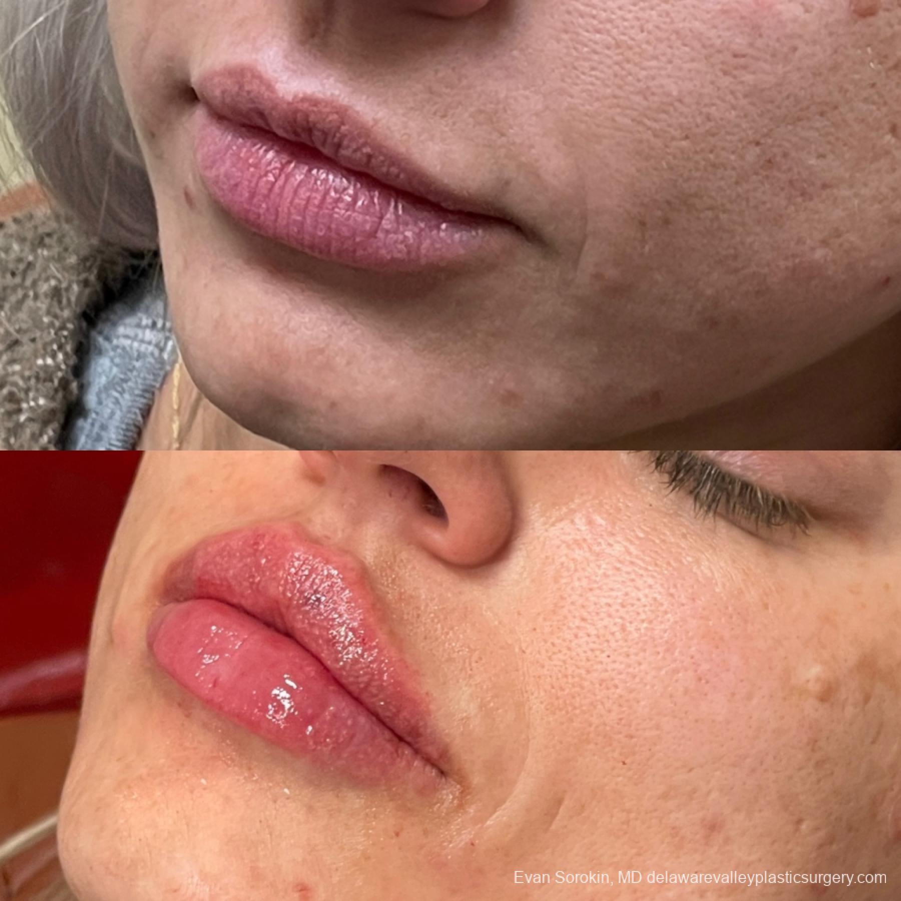 Lip Augmentation: Patient 58 - Before and After 3