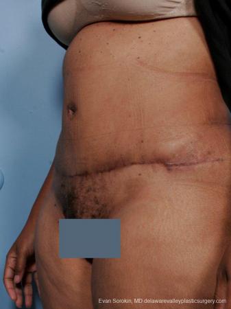 Philadelphia Abdominoplasty 9461 - After Image 4