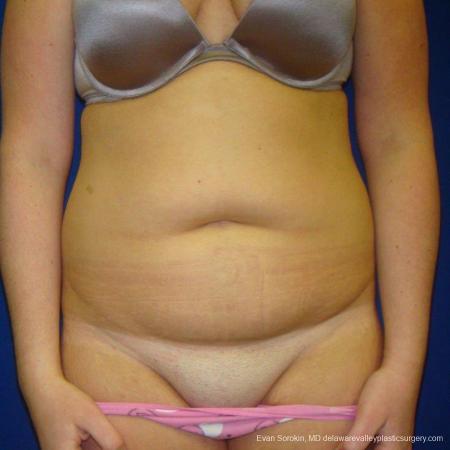 Philadelphia Liposuction 9484 - Before Image 1