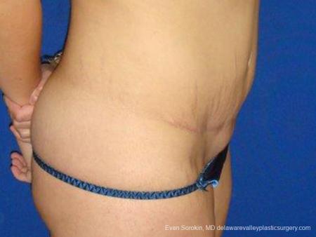 Philadelphia Abdominoplasty 9473 - After Image 3