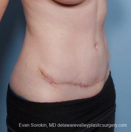 Philadelphia Abdominoplasty 8681 - After Image 2