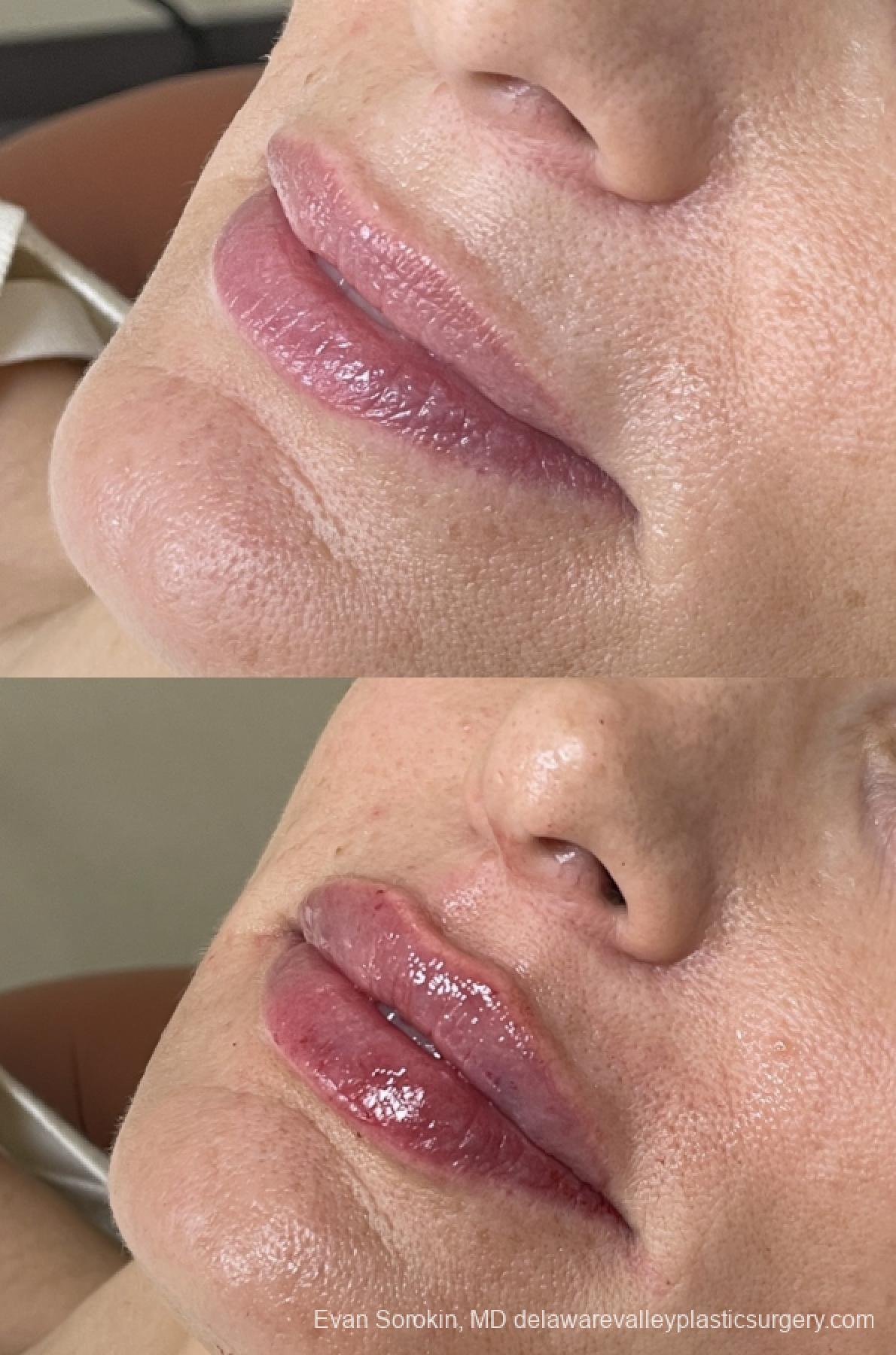 Lip Filler: Patient 62 - Before and After 3