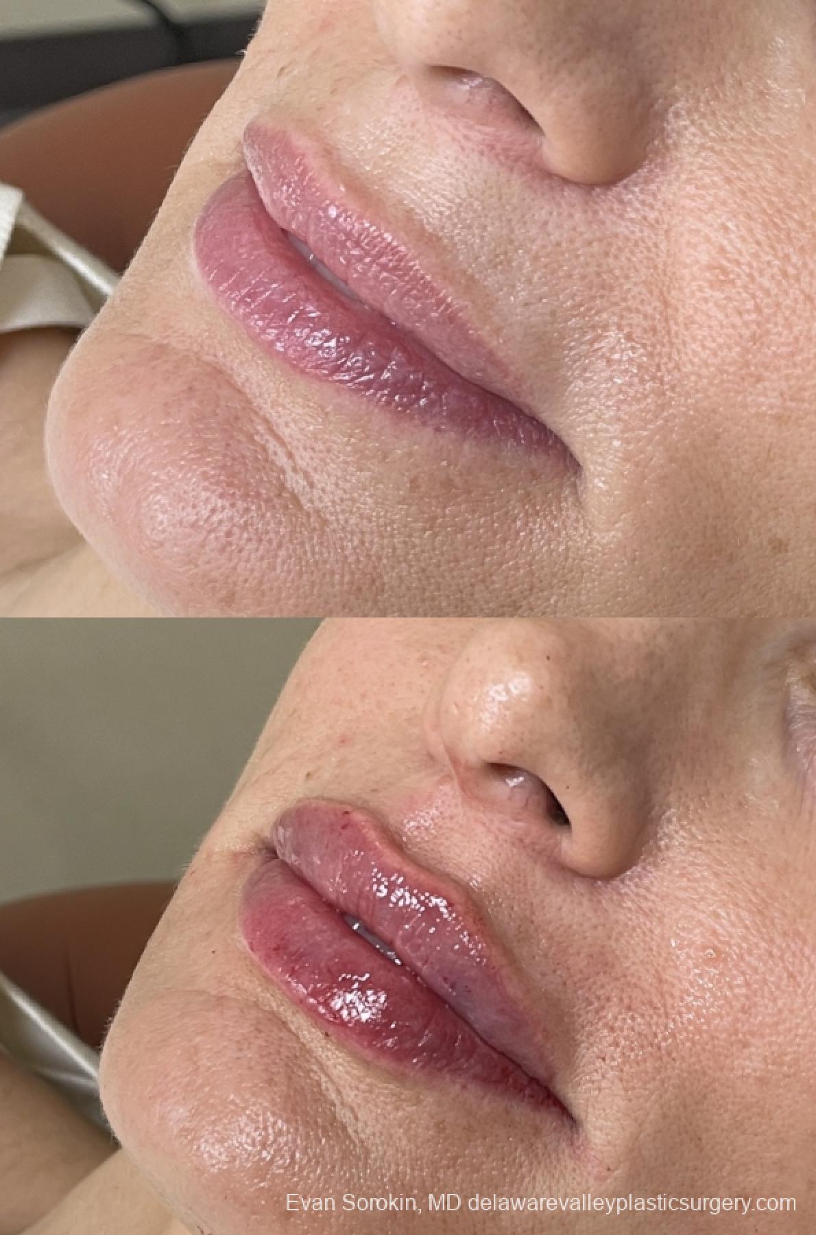 Lip Filler: Patient 61 - Before and After 3