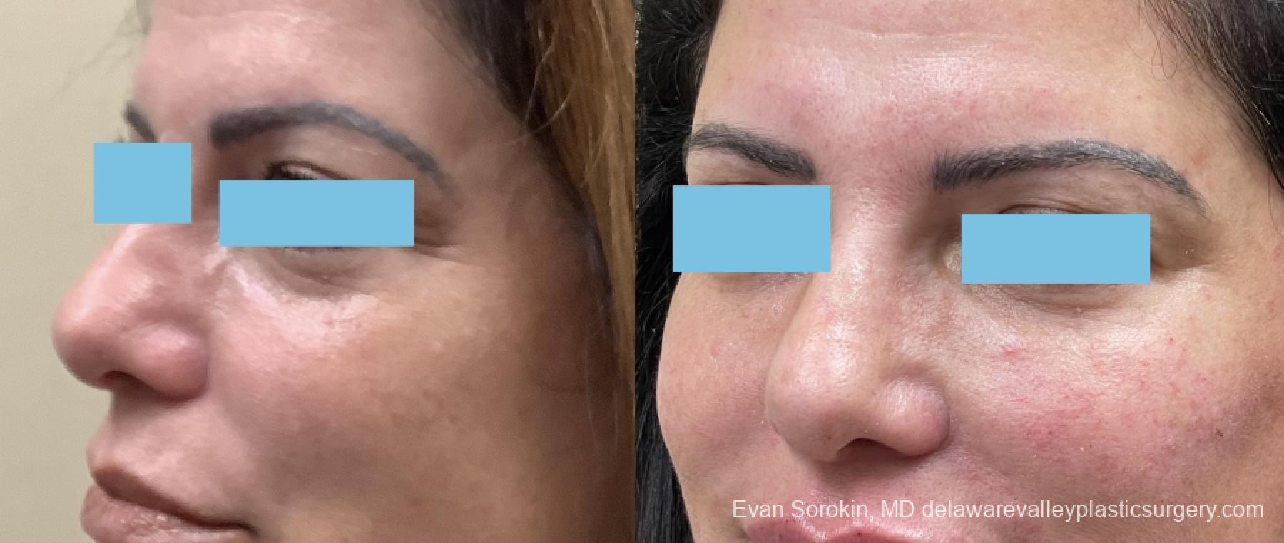 Fillers: Patient 42 - Before and After 