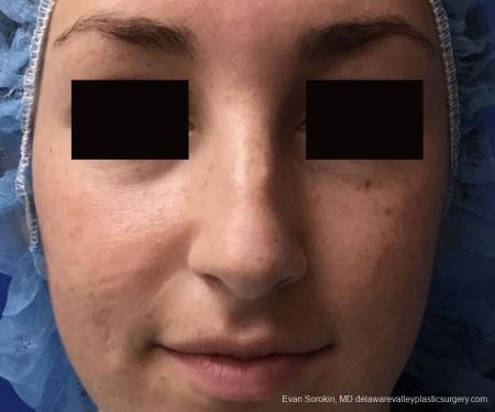 Rhinoplasty: Patient 2 - Before and After Image 2