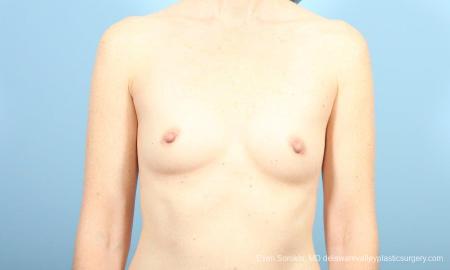 Philadelphia Breast Augmentation 8662 - Before Image 1