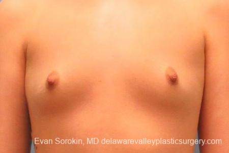 Philadelphia Breast Augmentation 10113 - Before Image 1