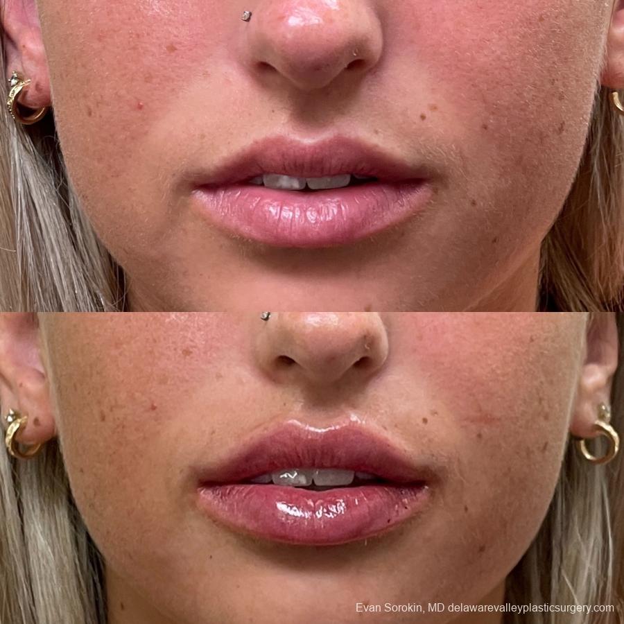 Lip Augmentation: Patient 9 - Before and After 1