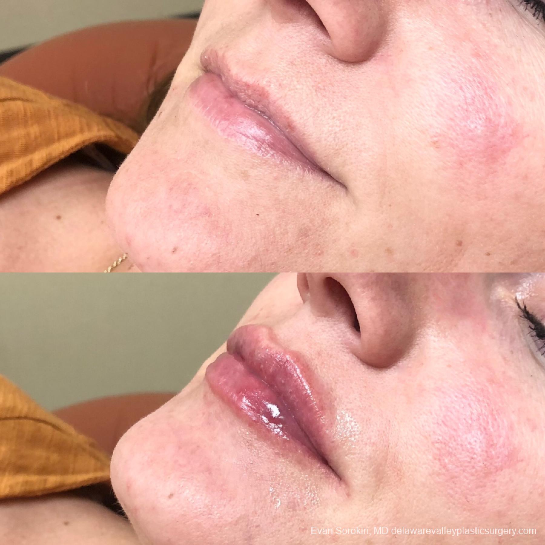 Lip Augmentation: Patient 27 - Before and After 2