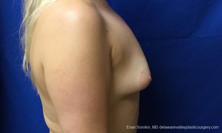 Philadelphia Breast Augmentation 12517 - Before Image 4