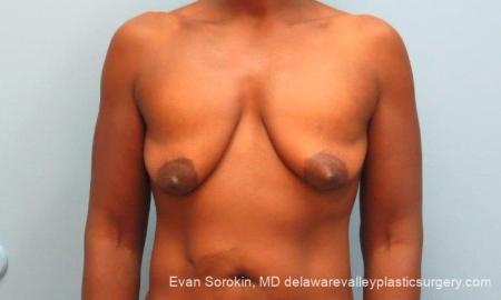 Philadelphia Breast Lift and Augmentation 10120 - Before Image 1