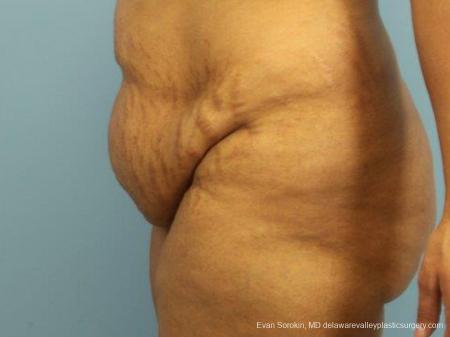 Philadelphia Abdominoplasty 9462 - Before and After Image 5