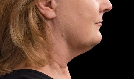 CoolSculpting®: Patient 6 - After Image 1