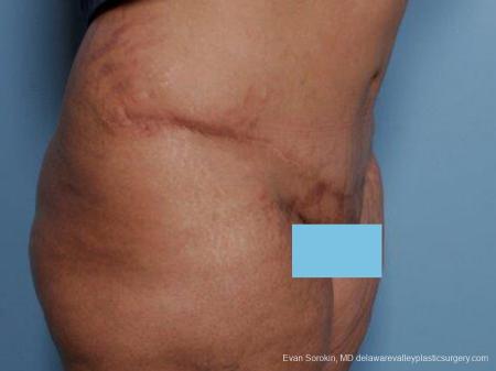 Philadelphia Abdominoplasty 9462 - After Image 2