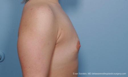 Philadelphia Breast Augmentation 9378 - Before Image 3