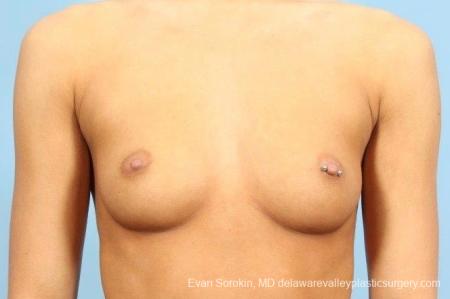Philadelphia Breast Augmentation 8769 - Before Image 1