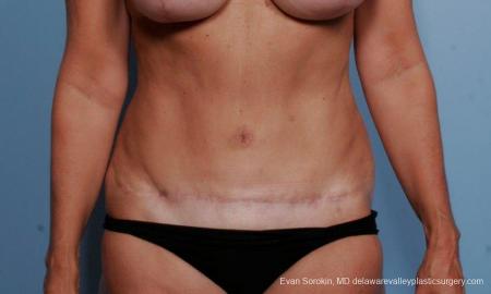 Philadelphia Abdominoplasty 9376 - After Image 1