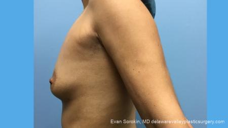 Breast Augmentation: Patient 137 - Before Image 3