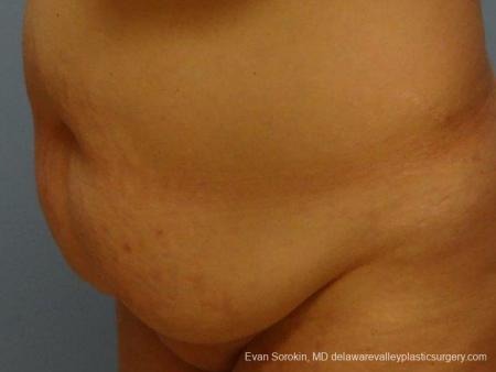 Philadelphia Abdominoplasty 9467 - Before Image 4