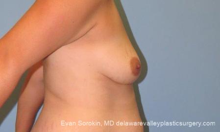 Philadelphia Breast Lift and Augmentation 10123 - Before Image 3