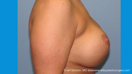 Philadelphia Breast Augmentation 10089 - Before Image 3