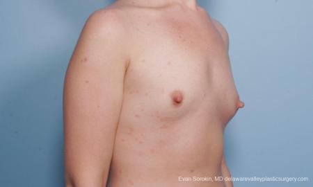 Philadelphia Breast Augmentation 9176 - Before Image 2