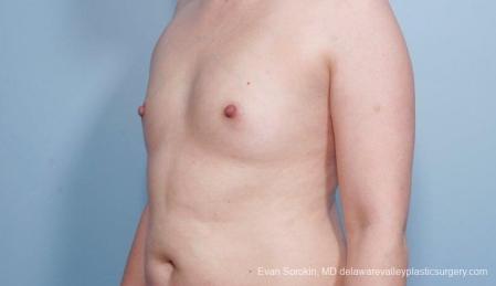 Breast Augmentation: Patient 54 - Before Image 4