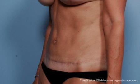 Philadelphia Abdominoplasty 9376 - After Image 4
