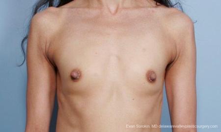 Philadelphia Breast Augmentation 9424 - Before Image 1