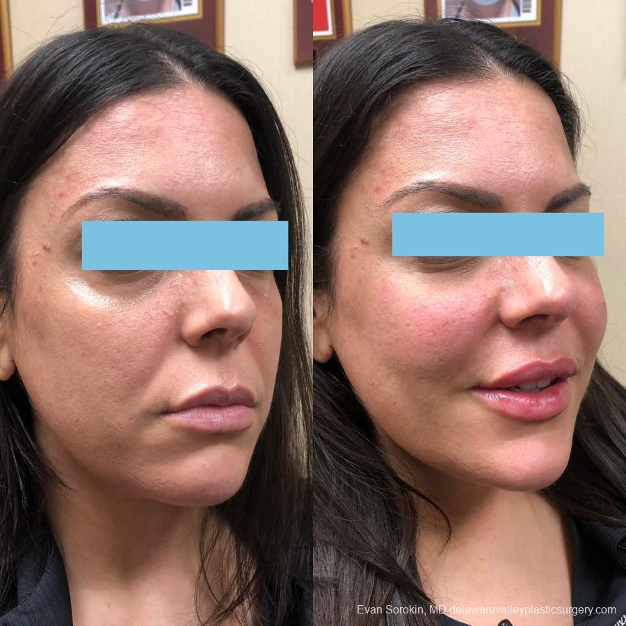 Fillers: Patient 48 - Before and After 1