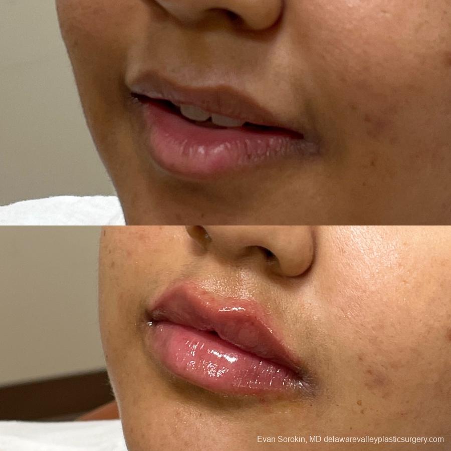 Lip Augmentation: Patient 23 - Before and After 3