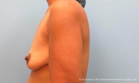 Philadelphia Breast Lift and Augmentation 9343 - Before and After Image 5