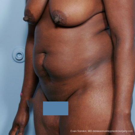 Philadelphia Abdominoplasty 9477 - Before Image 4