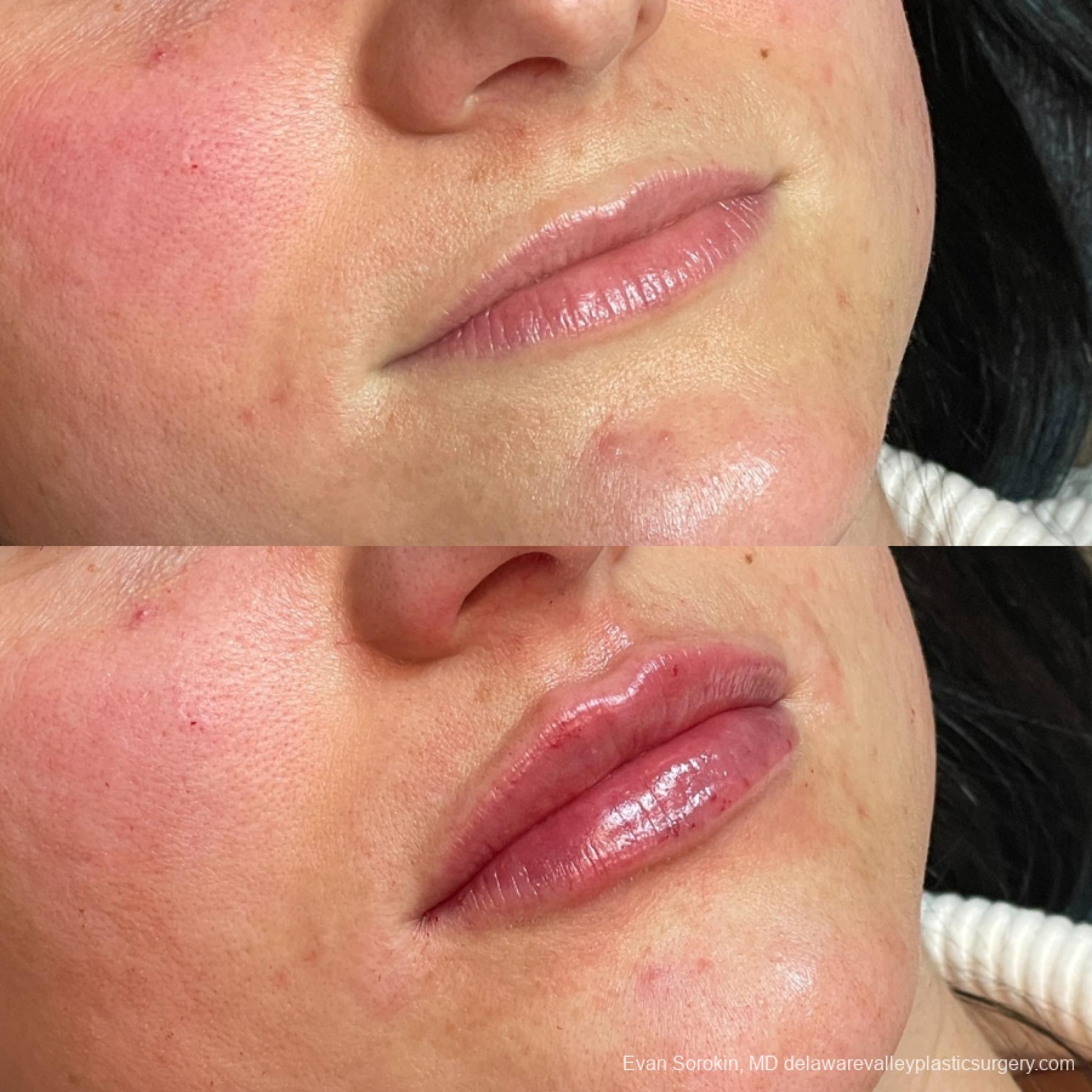 Lip Filler: Patient 53 - Before and After 2