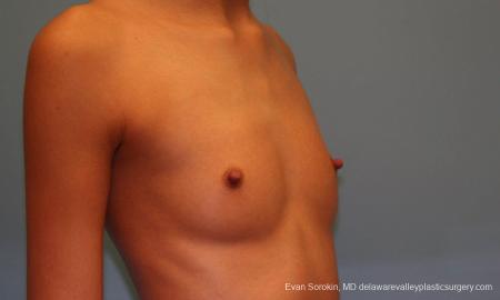 Philadelphia Breast Augmentation 9377 - Before Image 2