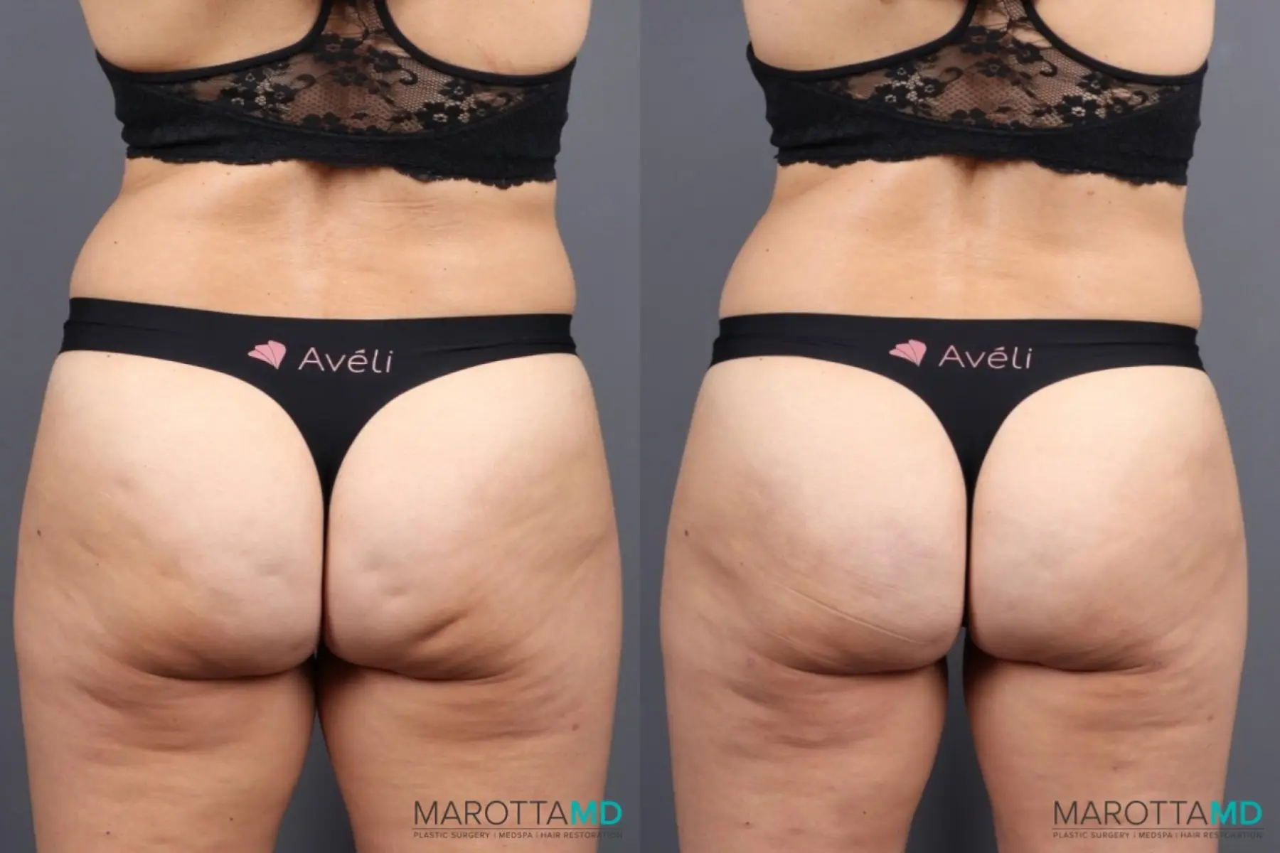 Cellulite Reduction - Before and After  