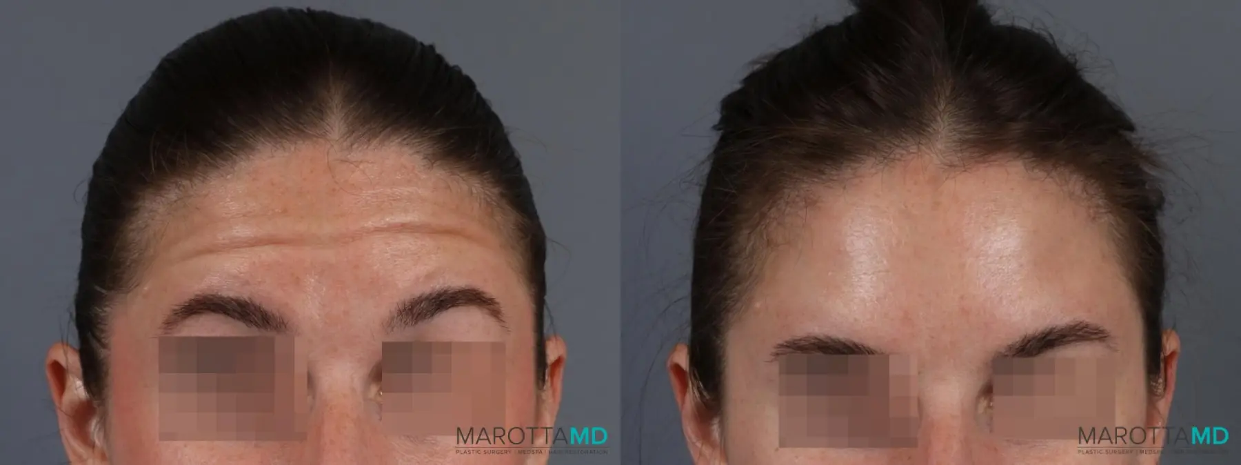BOTOX® Cosmetic: Patient 3 - Before and After  