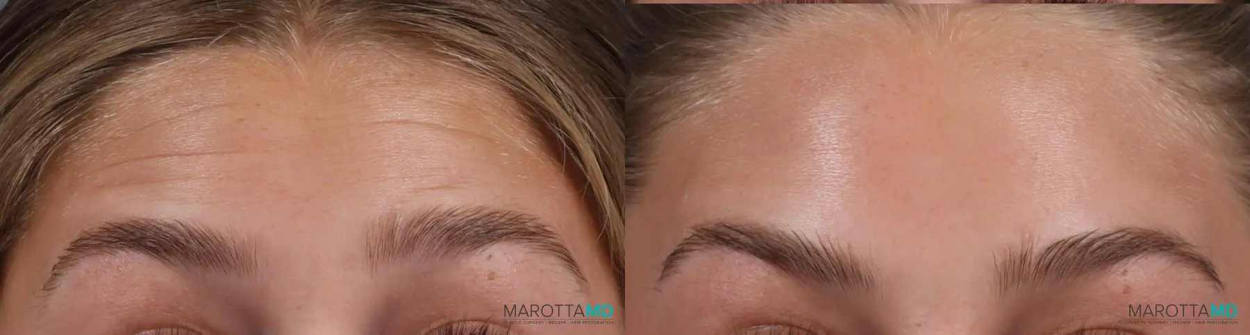 BOTOX® Cosmetic: Patient 5 - Before and After  