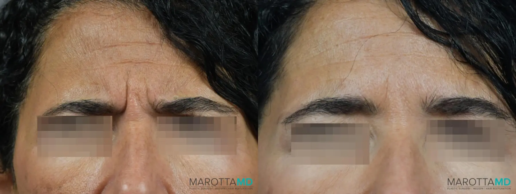 BOTOX® Cosmetic: Patient 8 - Before and After  
