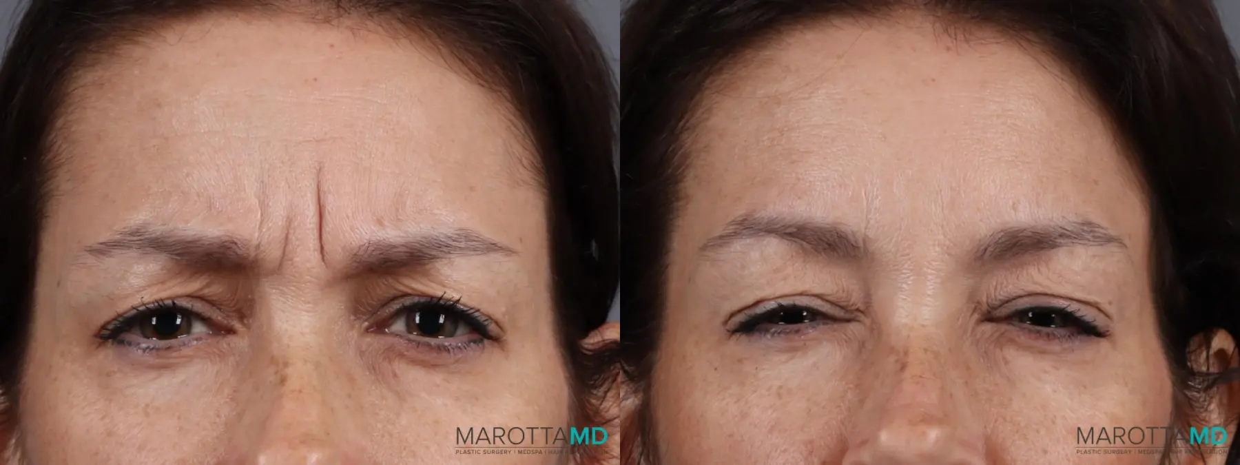 BOTOX® Cosmetic: Patient 6 - Before and After  