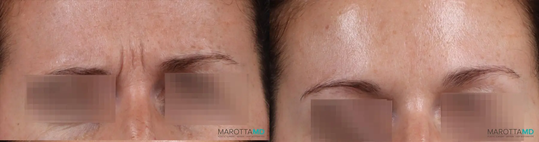 BOTOX® Cosmetic: Patient 2 - Before and After  