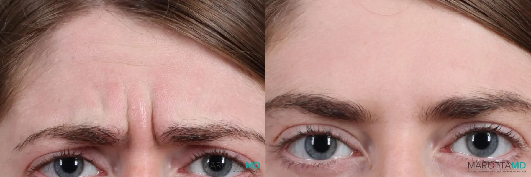 BOTOX® Cosmetic: Patient 9 - Before and After  