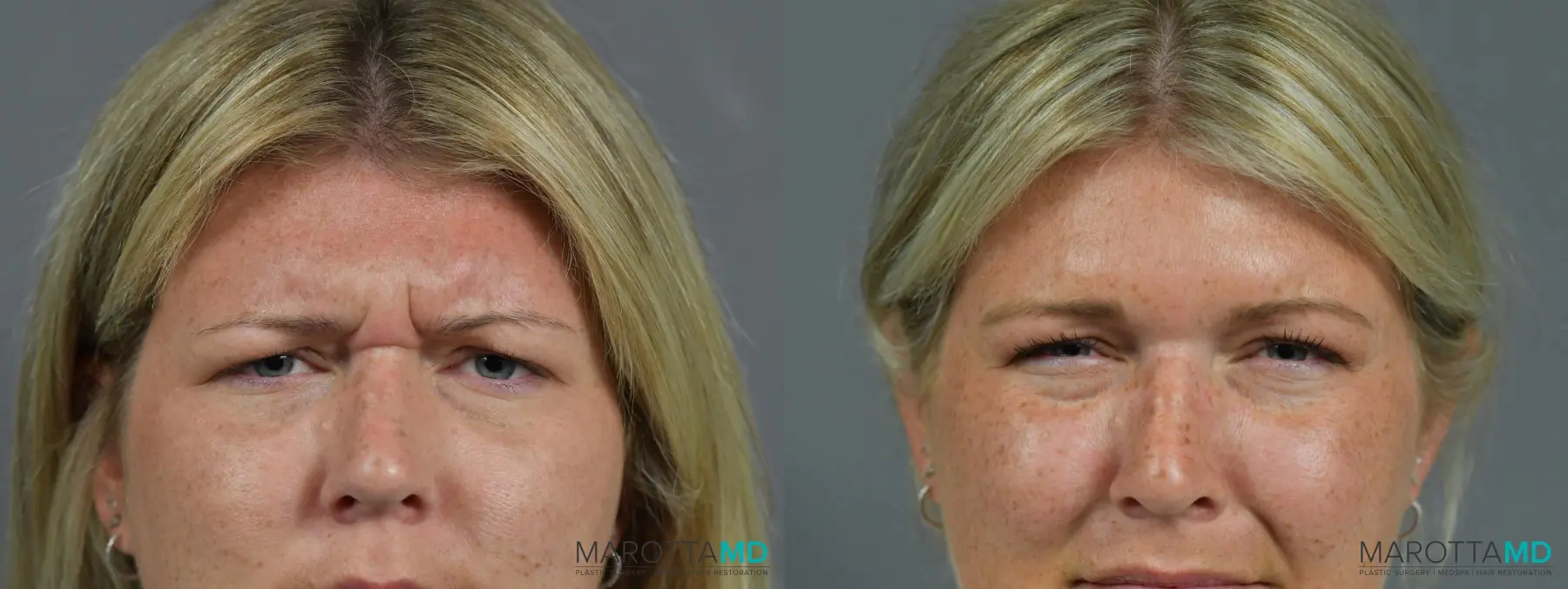 BOTOX® Cosmetic: Patient 4 - Before and After  