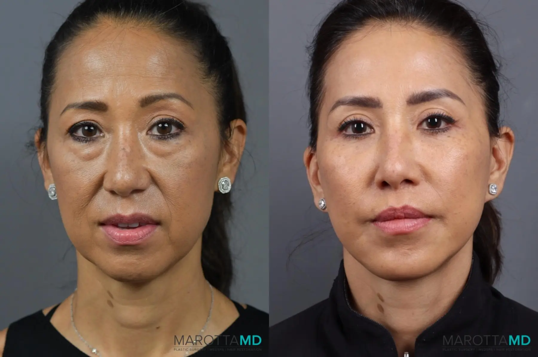Buccal Fat Removal: Patient 3 - Before and After  