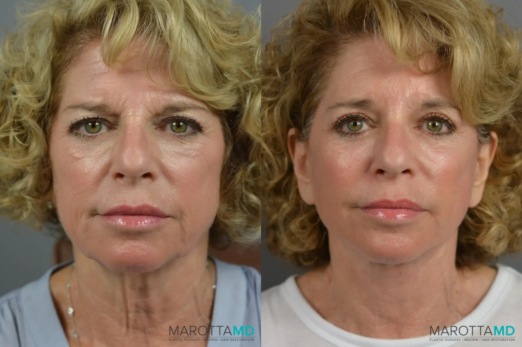 Facelift & Neck Lift: Patient 6 - Before and After  