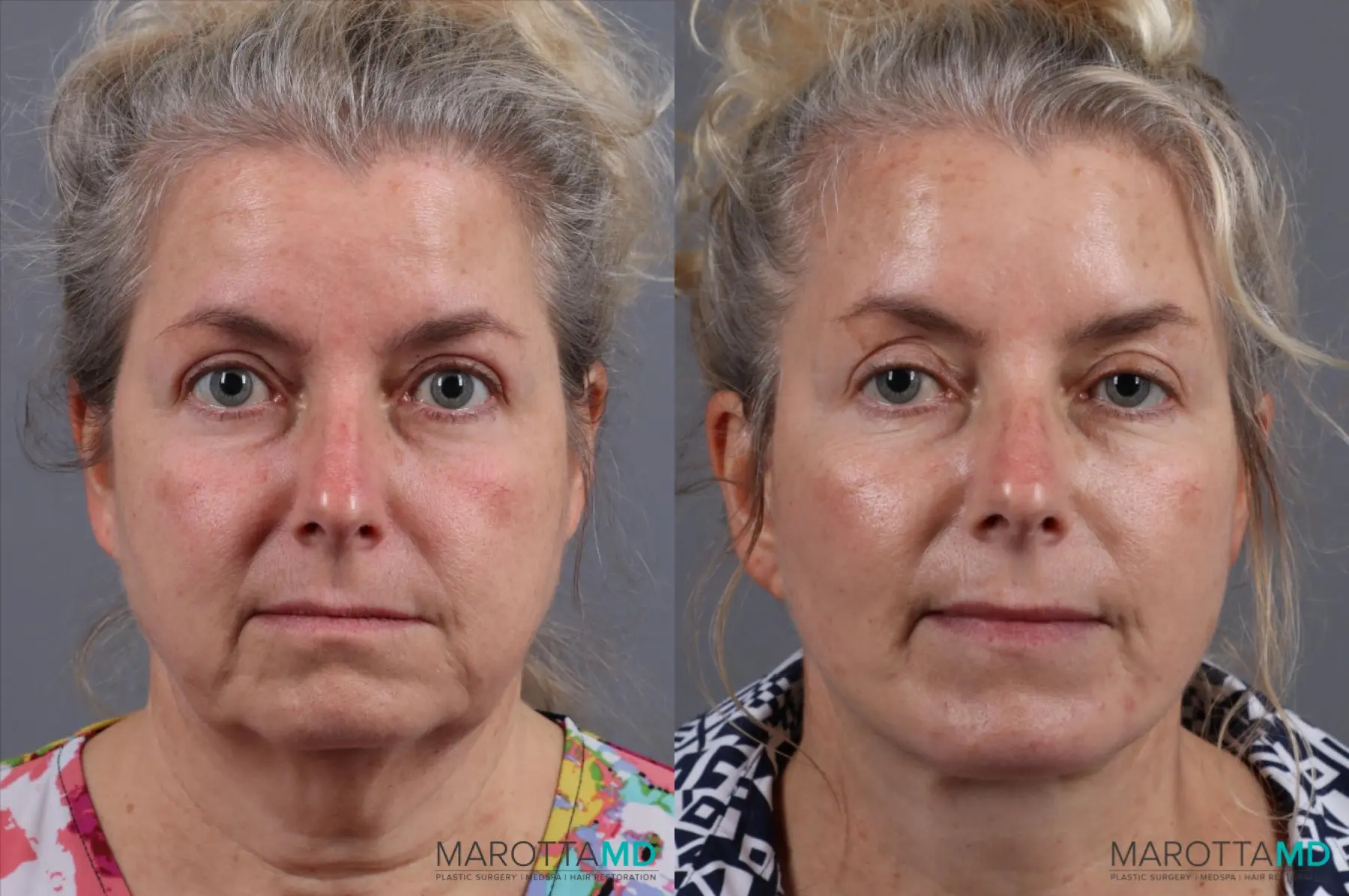 Facelift & Neck Lift: Patient 8 - Before and After  