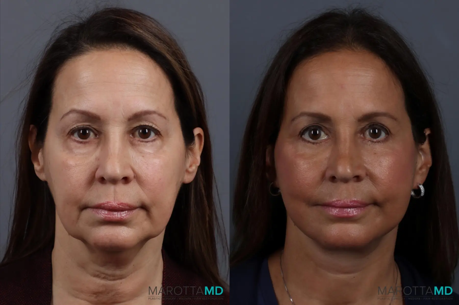 Facelift & Neck Lift: Patient 9 - Before and After  