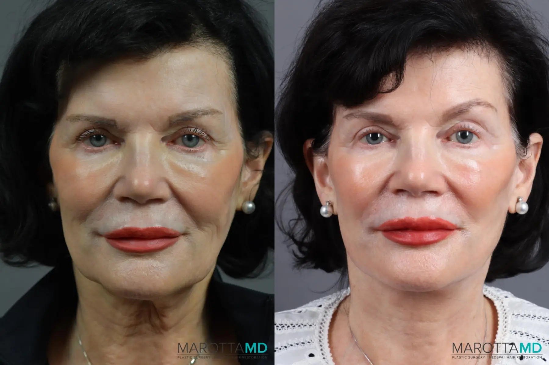 Facelift & Neck Lift: Patient 10 - Before and After  
