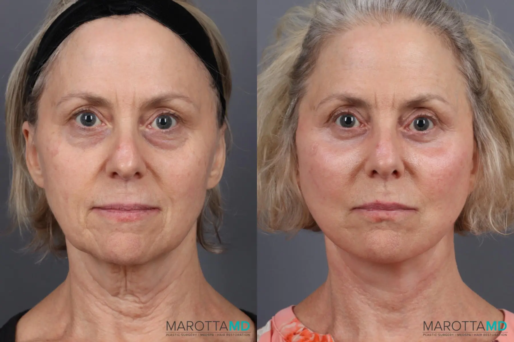 Facelift & Neck Lift: Patient 7 - Before and After  