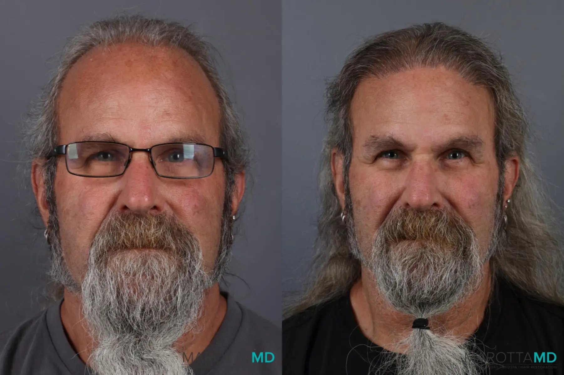 Hair Transplantation: Patient 5 - Before and After  